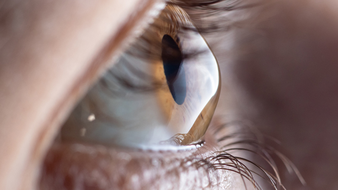 Macro eye photo. Keratoconus - eye disease, thinning of the cornea in the form of a cone. The cornea plastic