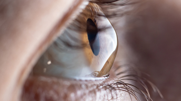 Macro eye photo. Keratoconus - eye disease, thinning of the cornea in the form of a cone. The cornea plastic