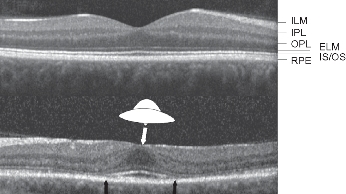 Hydroxychloroquine-Retinopathy-Flying-Saucer-Sign