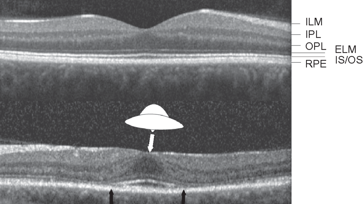 Hydroxychloroquine-Retinopathy-Flying-Saucer-Sign