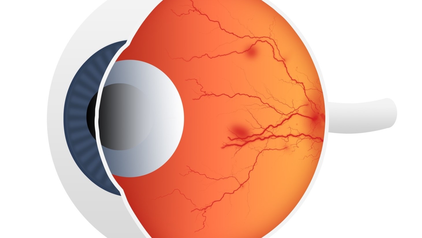 Illustration of hemorrhage in retina - Diabetic Retinopathy