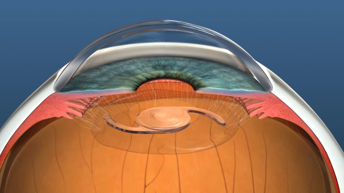 IOL-Image-2