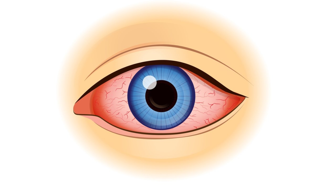 Eye redness symptom of human isolated on white.