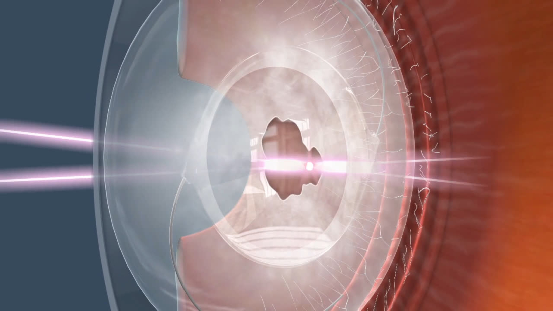 YAG-laser