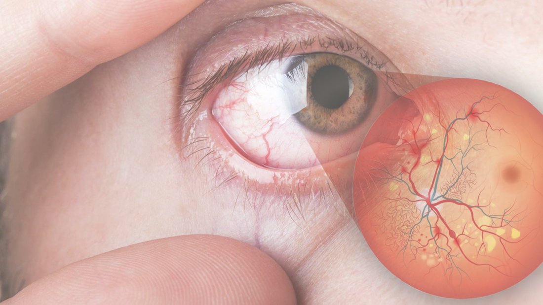 retinopatiacular