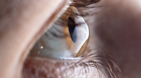 Macro eye photo. Keratoconus - eye disease, thinning of the cornea in the form of a cone. The cornea plastic.