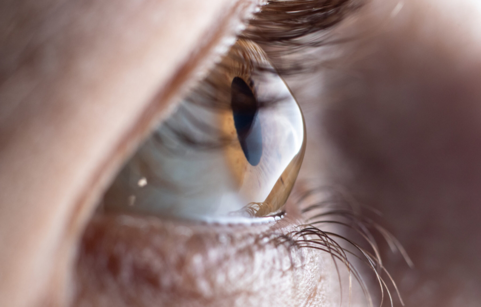 Macro eye photo. Keratoconus - eye disease, thinning of the cornea in the form of a cone. The cornea plastic.